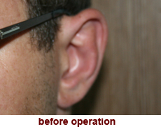 plastic-surgery-prominent-ear 